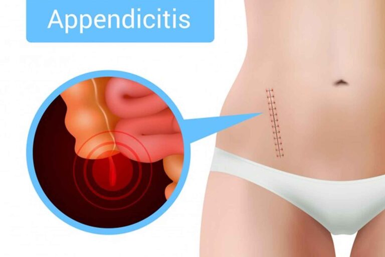 Everything You Need to Know About Appendicitis